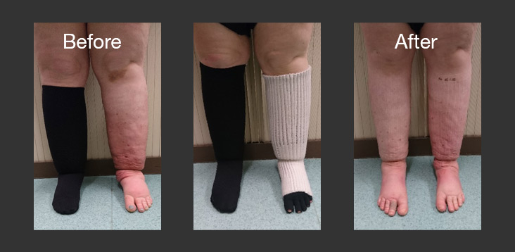 Lymphedema: What Is It and How Does Compression Clothing Help?